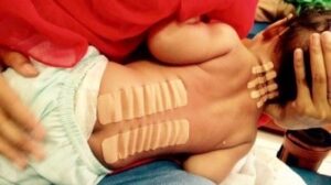 NeuroMusculkar Taping for postural control in Downs syndrome