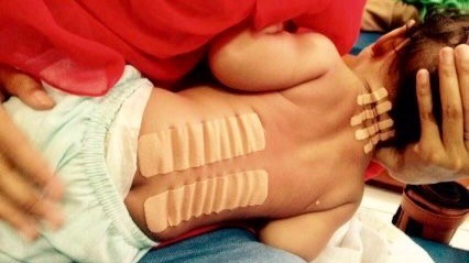 NeuroMusculkar Taping for postural control in Downs syndrome