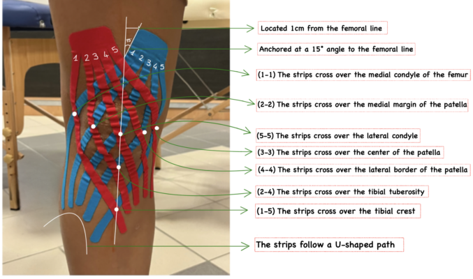 NeuroMuscular Taping double fan for Knee arthritis
