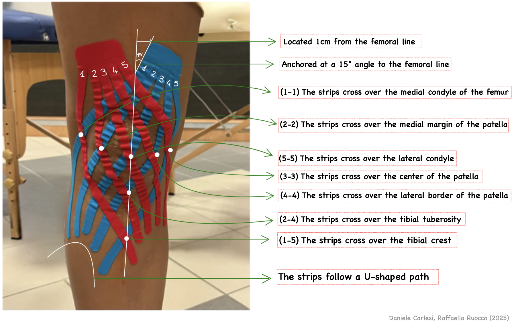 NeuroMuscular Taping double fan for Knee arthritis