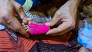 Pediatric clubfoot rehabilitation in Africa