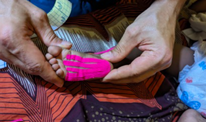Pediatric clubfoot rehabilitation in Africa