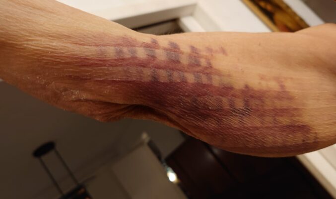 NMT treatment of PICC hematoma