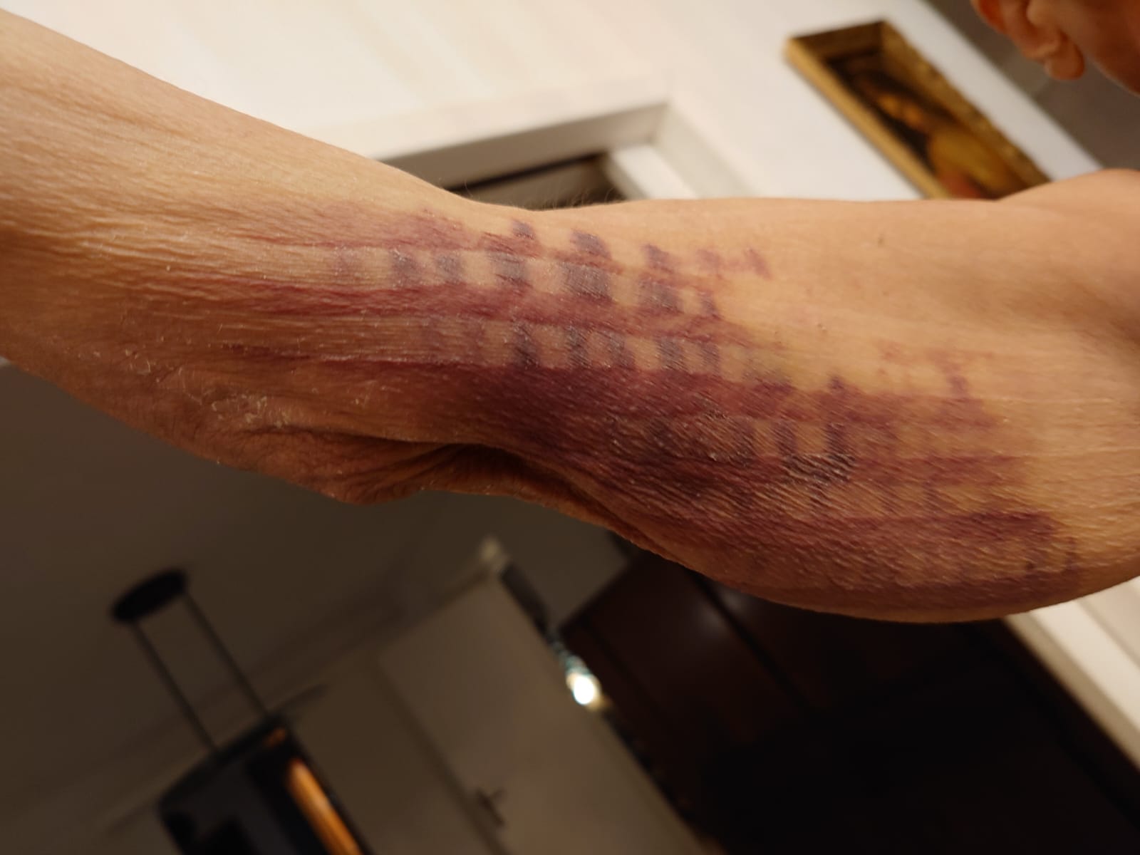 NMT treatment of PICC hematoma